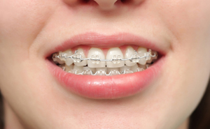 Orthodontie home-test